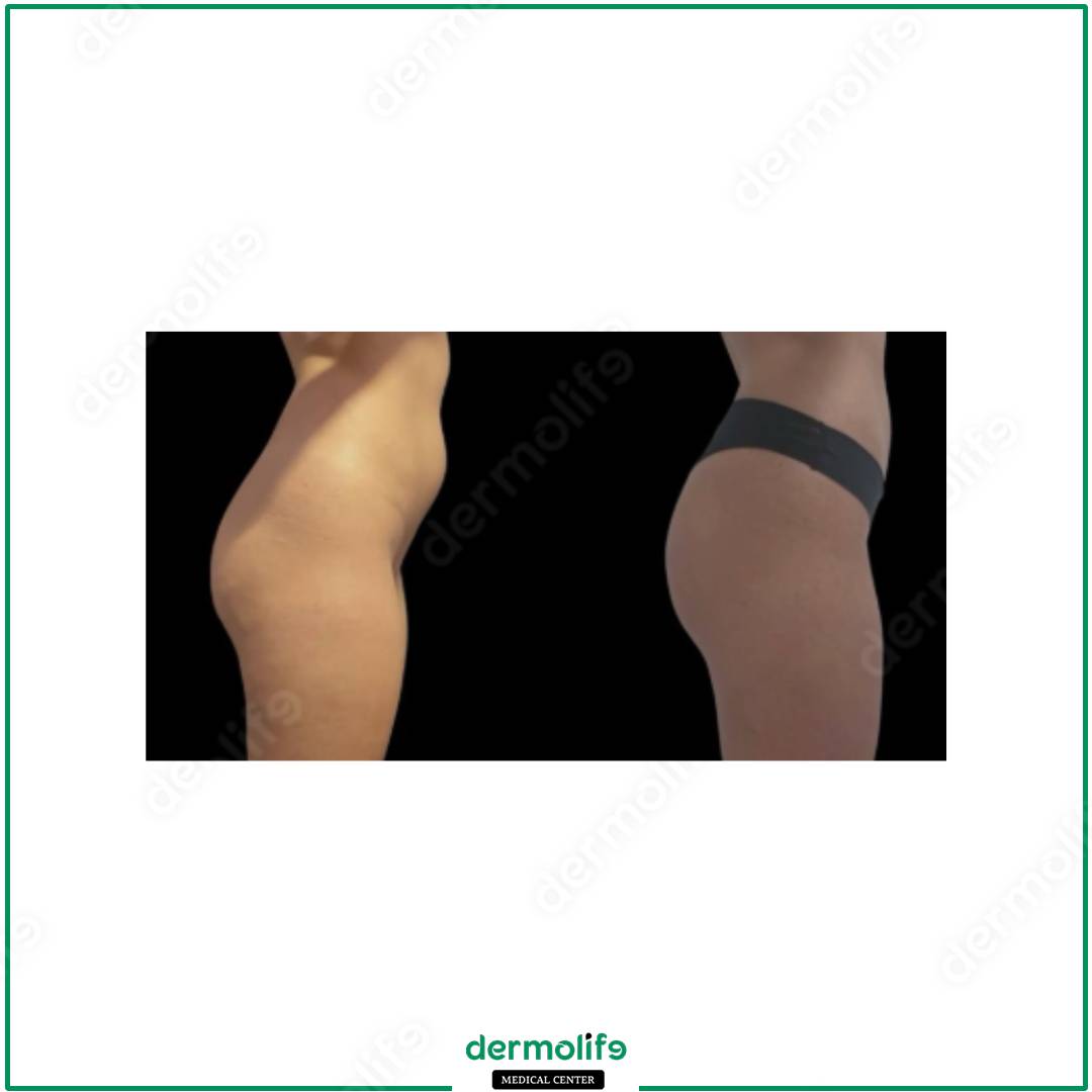 liposuzione clinica estetica italy 