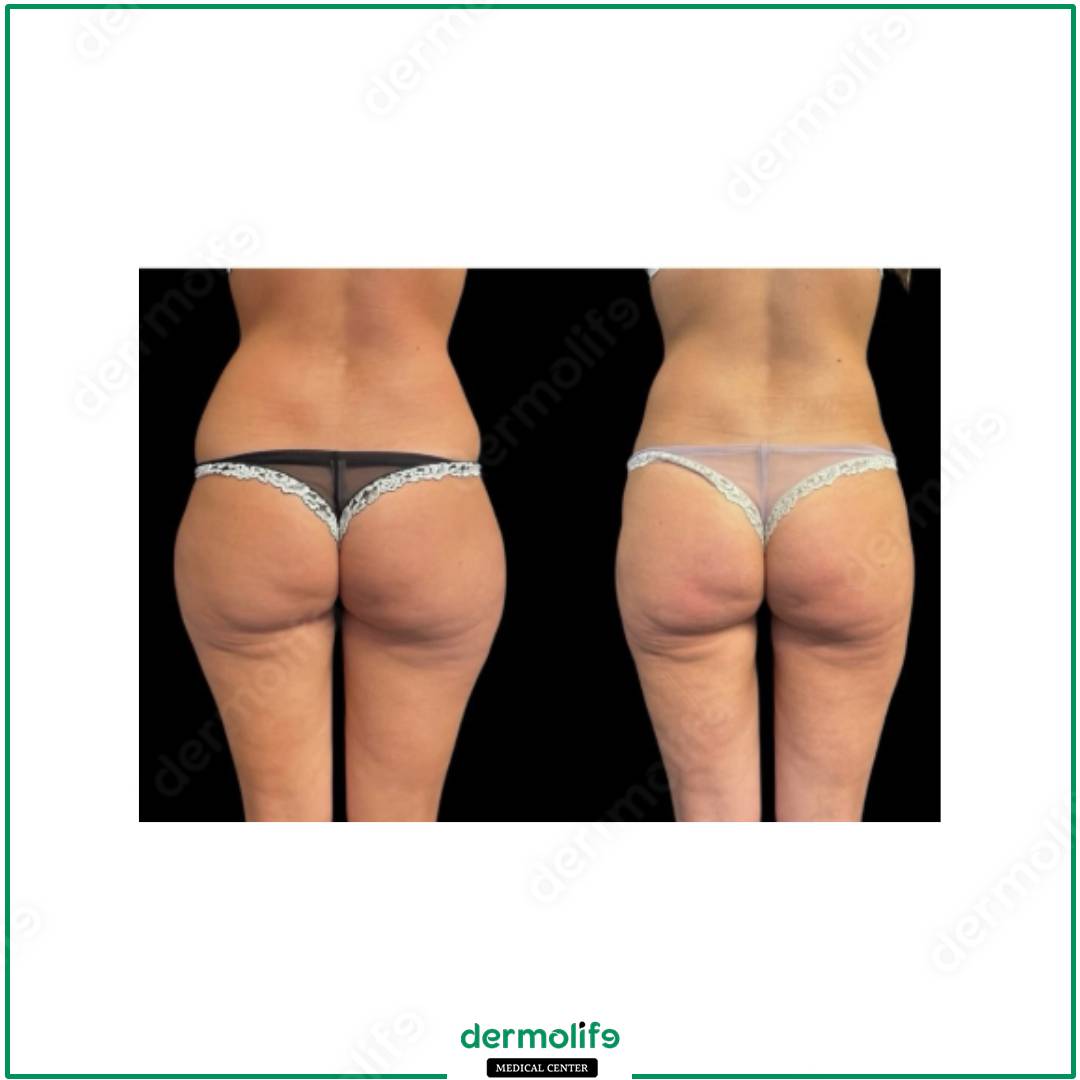 liposuzione clinica estetica italy 