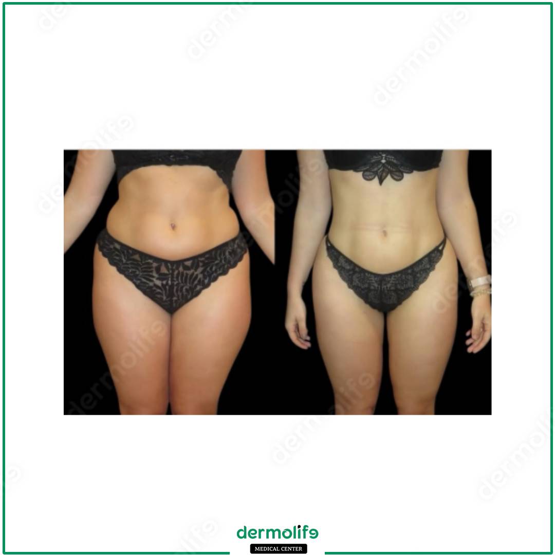 liposuzione clinica estetica italy 