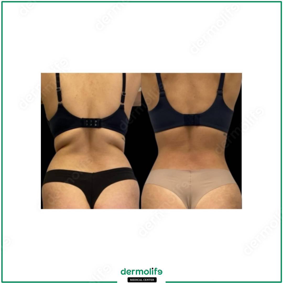 liposuzione clinica estetica italy 