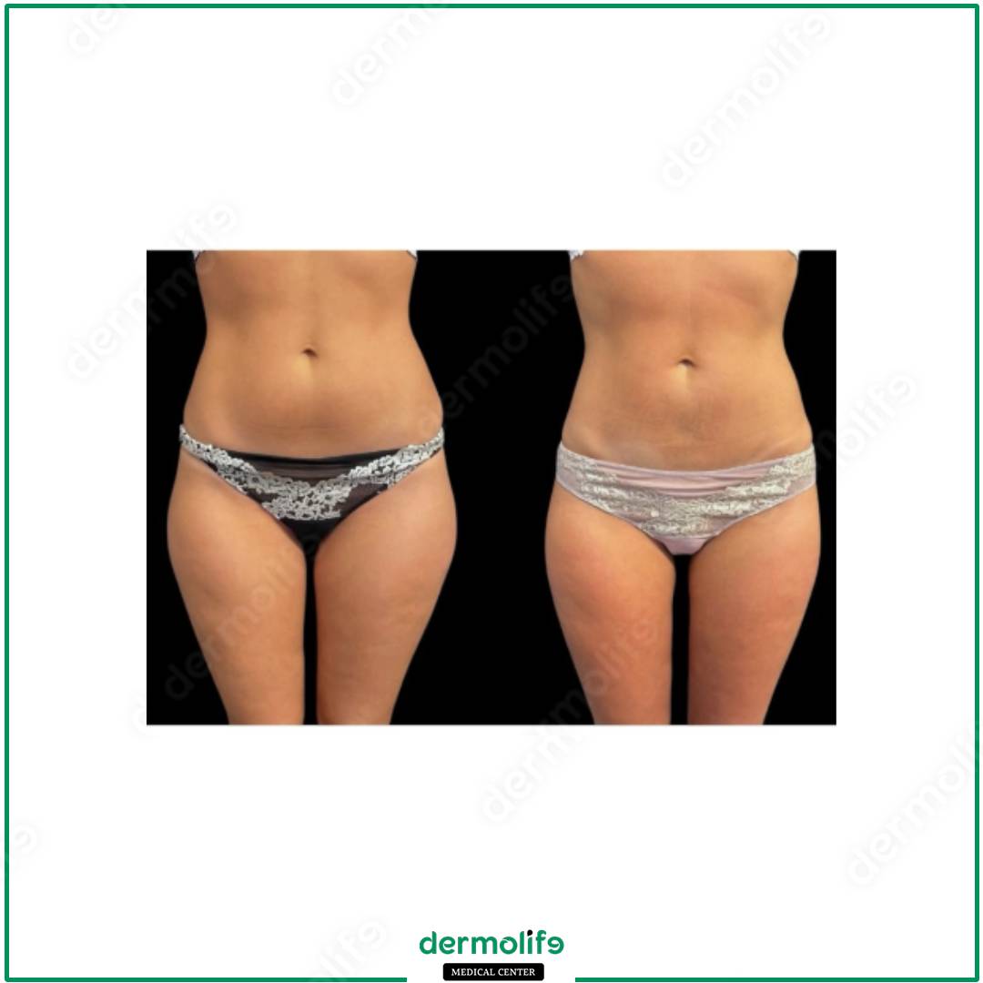 liposuzione clinica estetica italy 