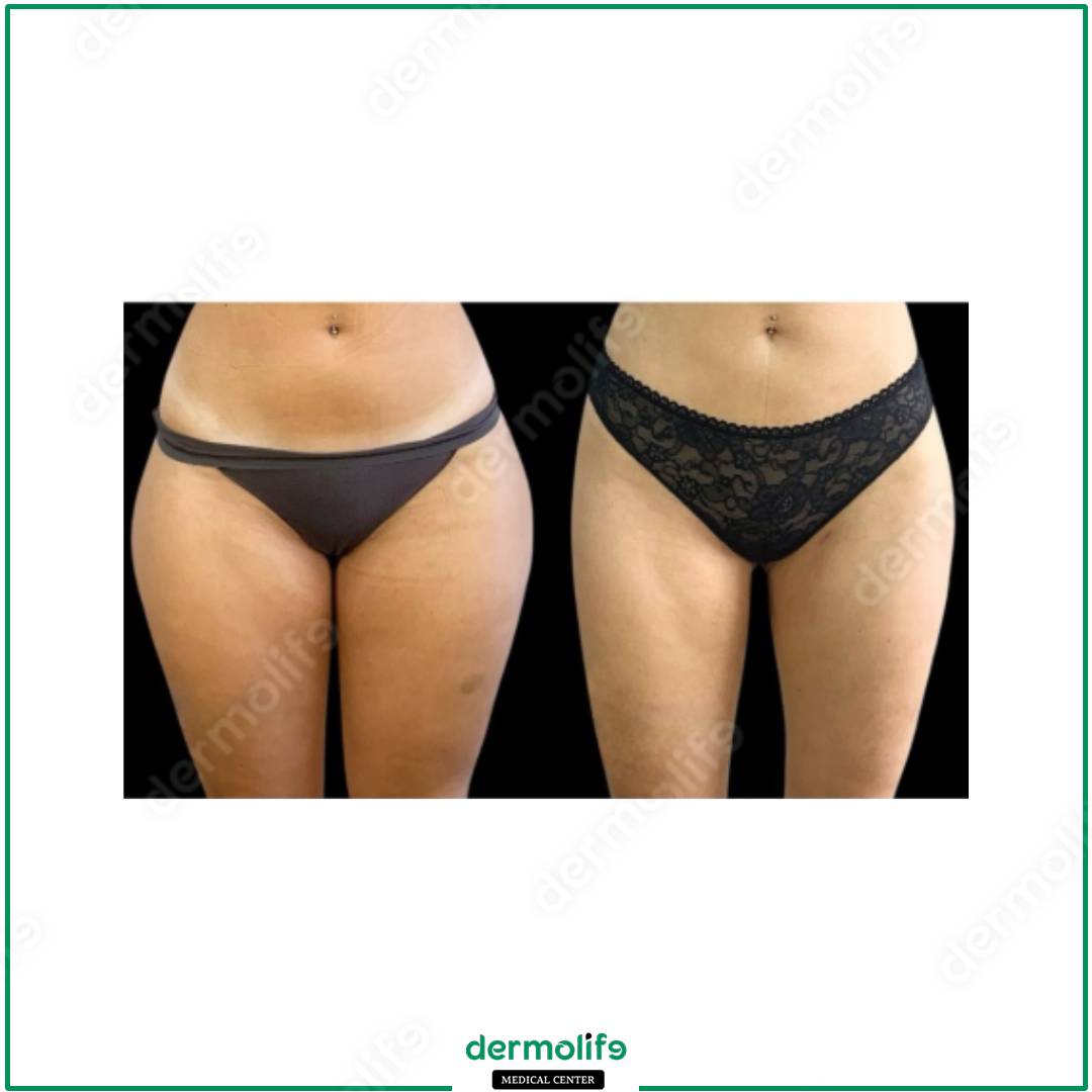 liposuzione clinica estetica italy 
