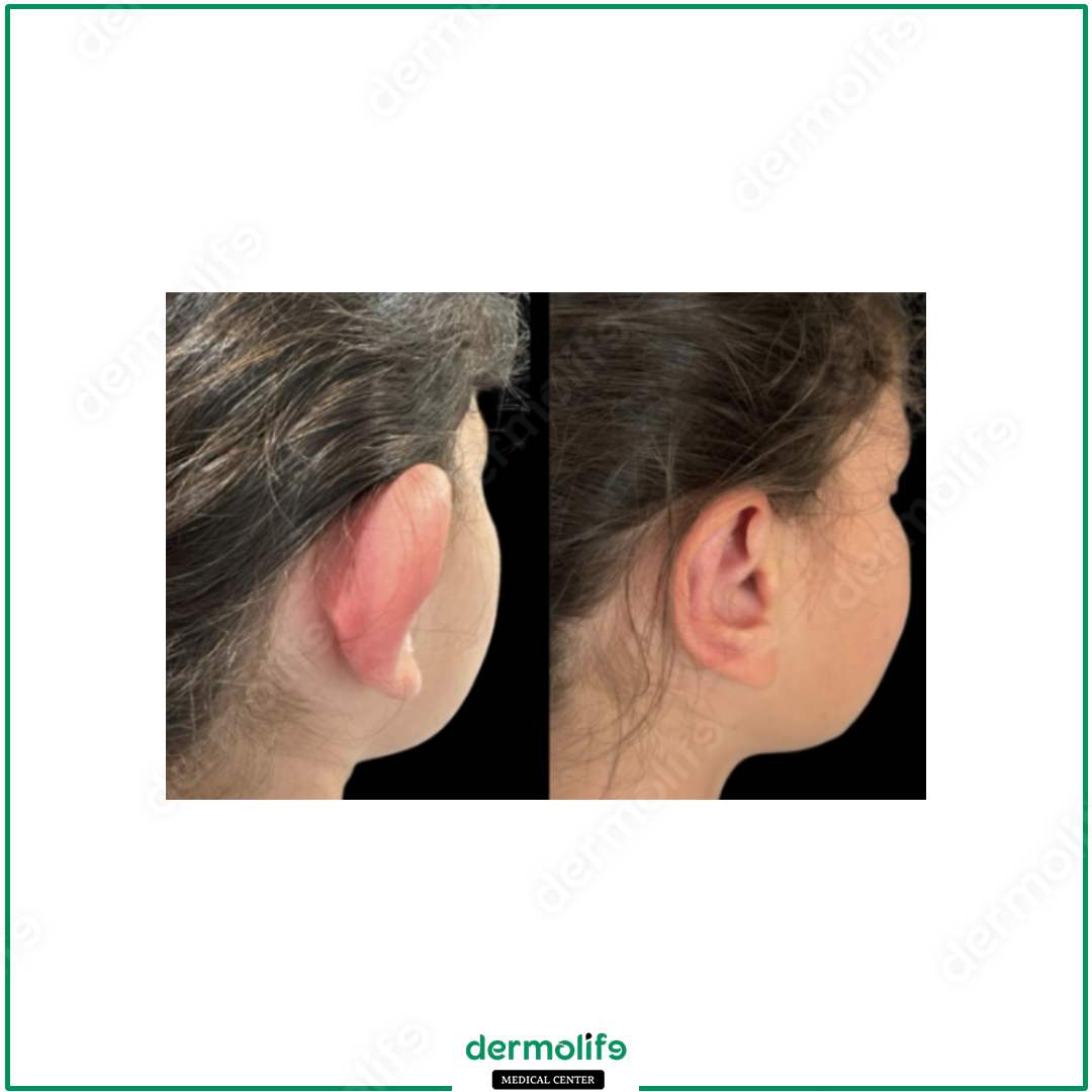 otoplastica clinica estetica italy 