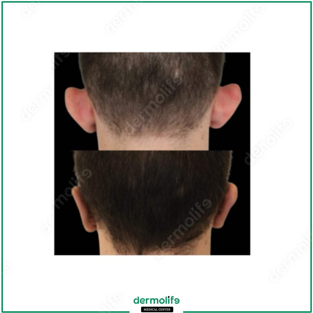 otoplastica clinica estetica italy 