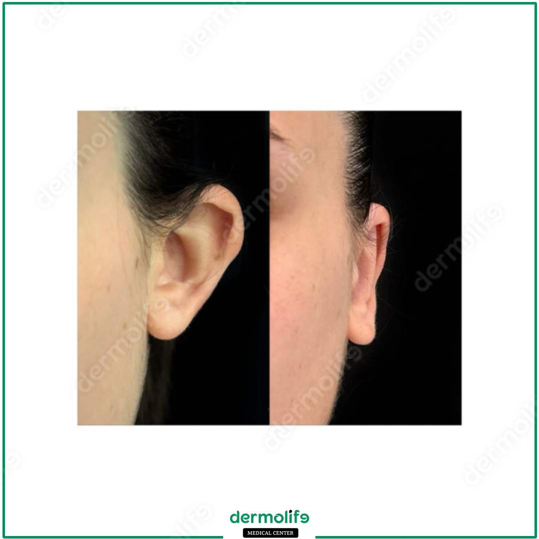 otoplastica clinica estetica italy 