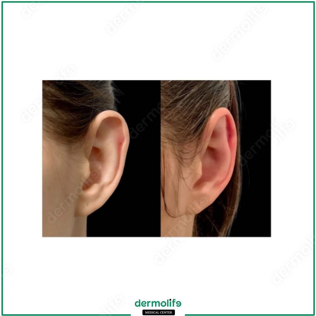 otoplastica clinica estetica italy 