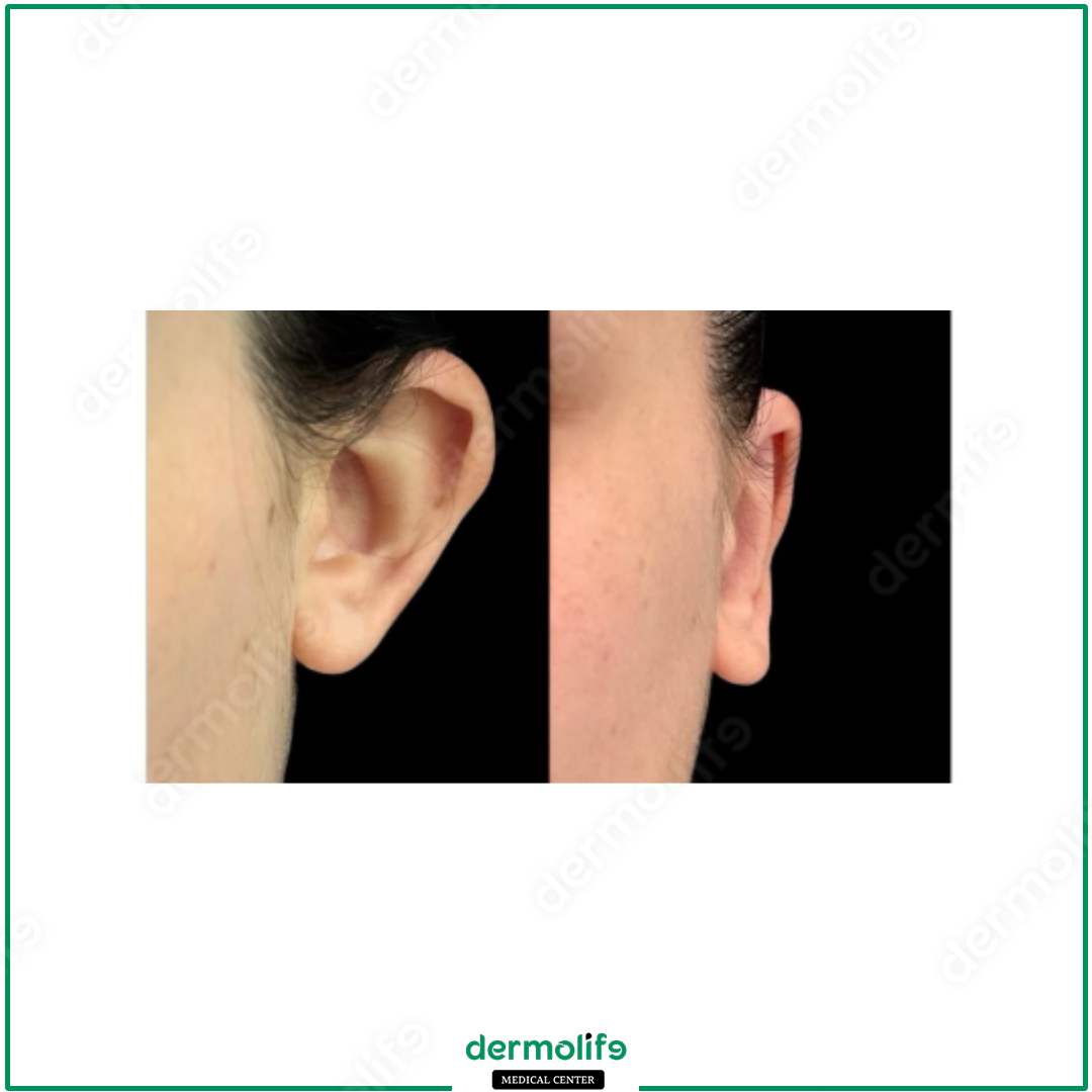 otoplastica clinica estetica italy 