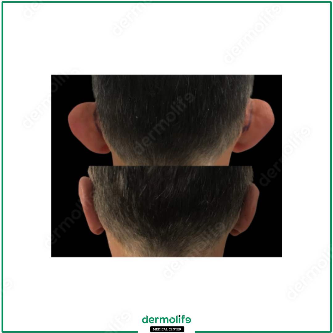 otoplastica clinica estetica italy 