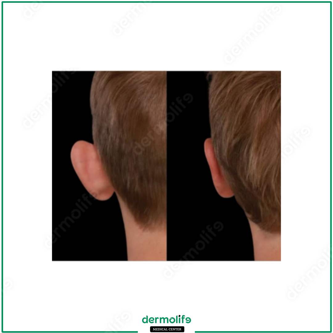 otoplastica clinica estetica italy 