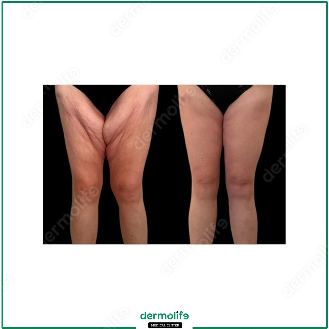 lifting cosce clinica estetica italy 