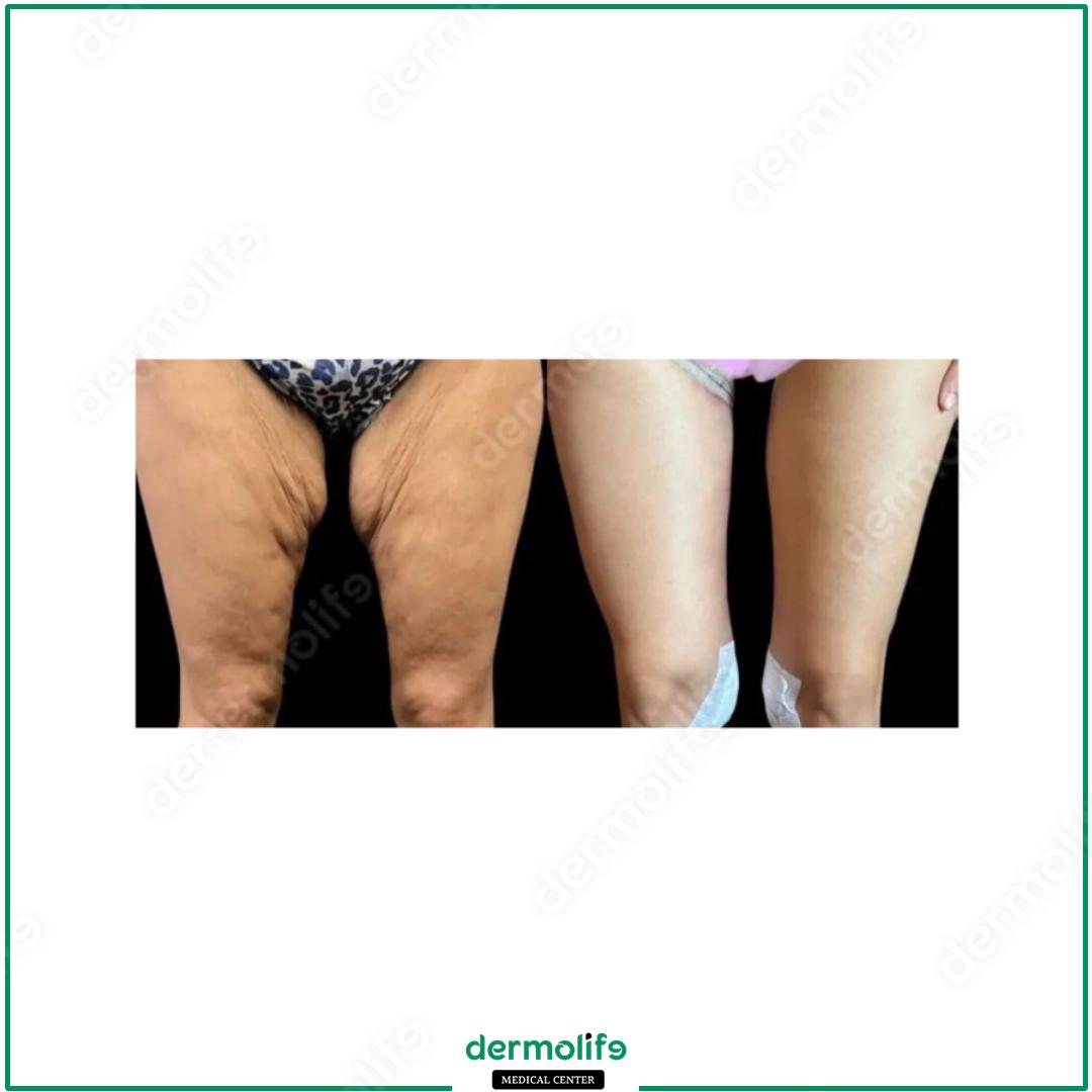 lifting cosce clinica estetica italy 