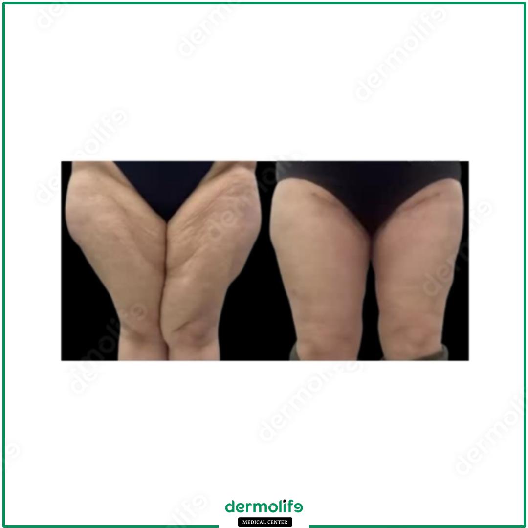 lifting cosce clinica estetica italy 