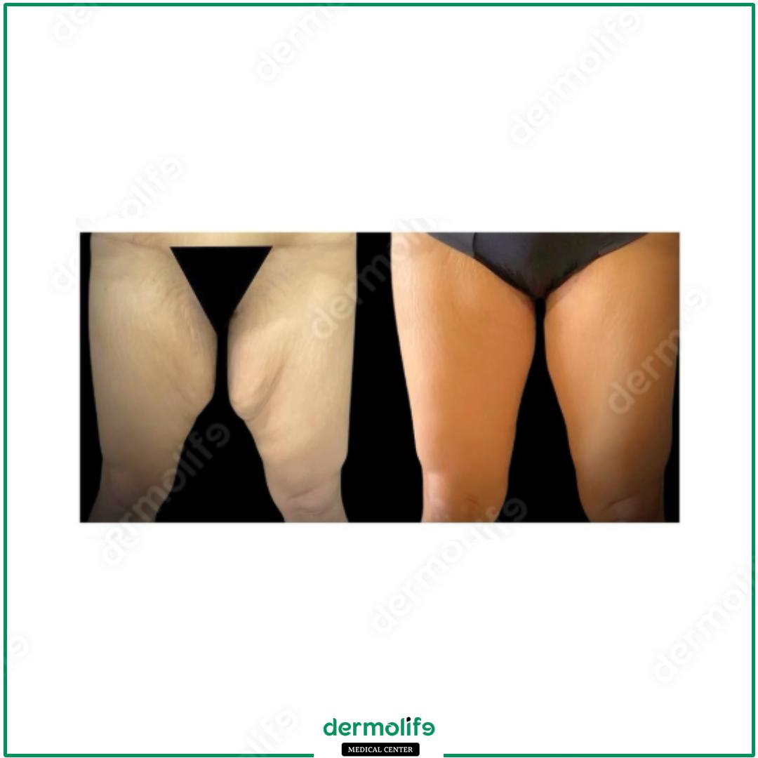 lifting cosce clinica estetica italy 
