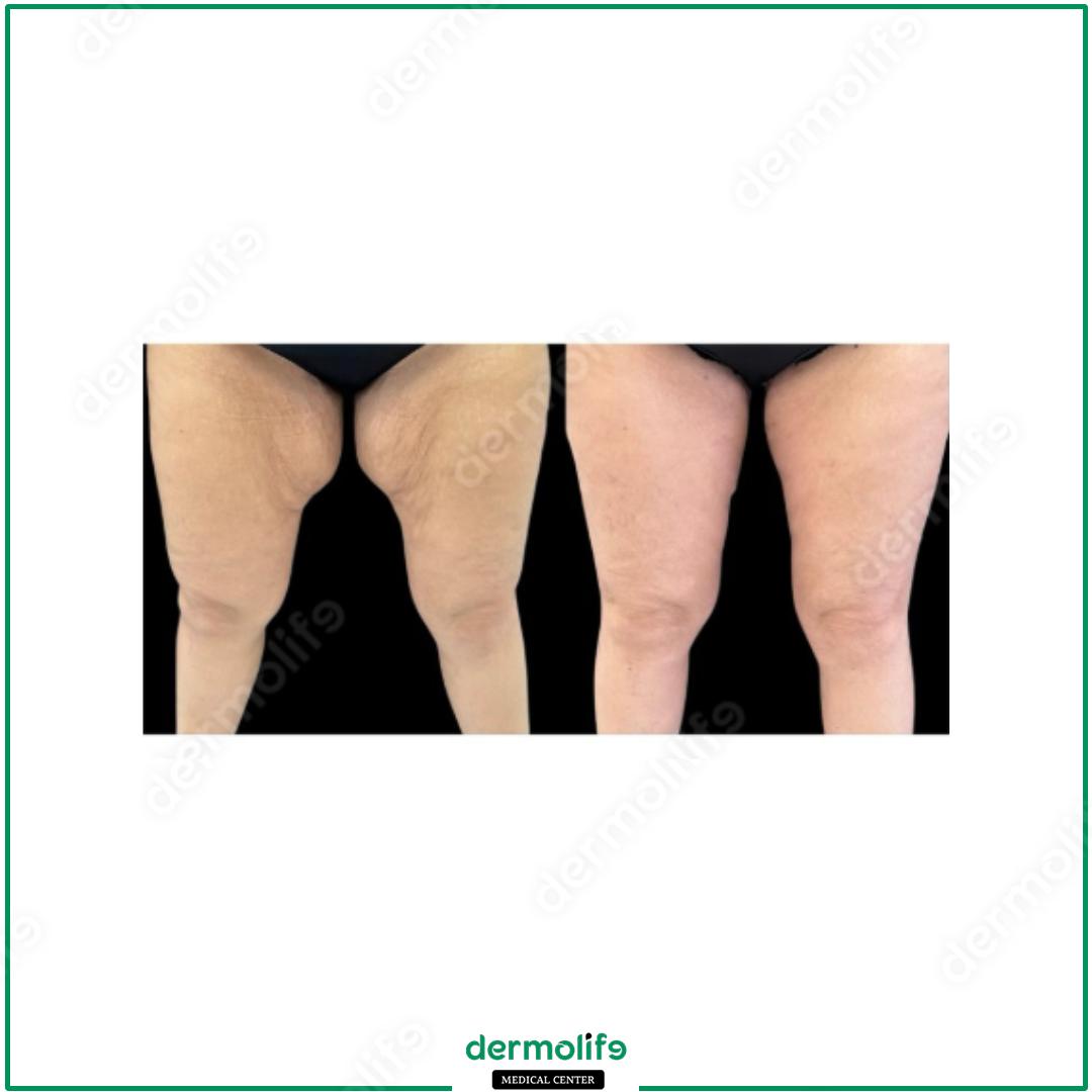 lifting cosce clinica estetica italy 