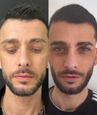 eyelid surgery 