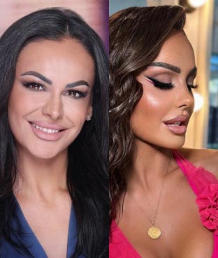 eyelid surgery 
