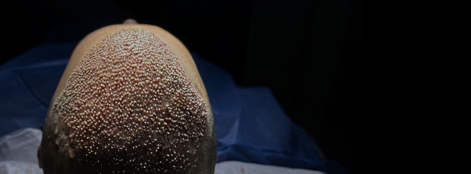 Transplanti i Flokeve 