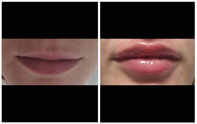 hyaluronic acid aesthetic clinic italy 