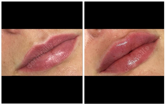 hyaluronic acid aesthetic clinic italy 