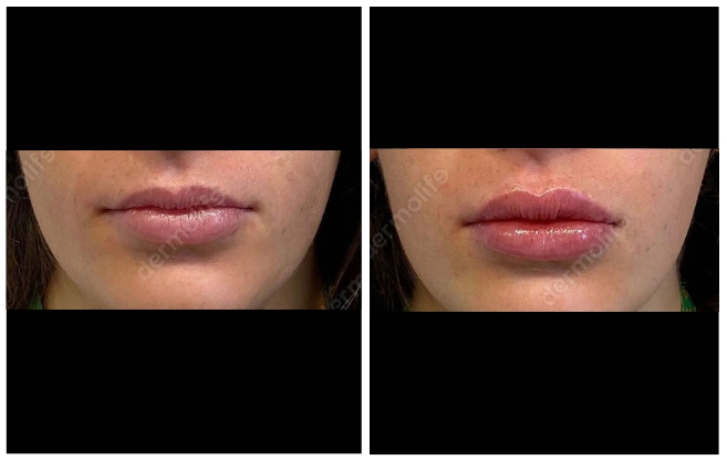 hyaluronic acid aesthetic clinic italy 
