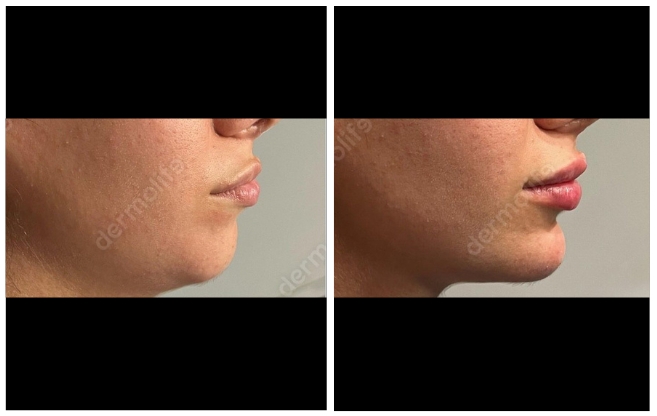 hyaluronic acid aesthetic clinic italy 