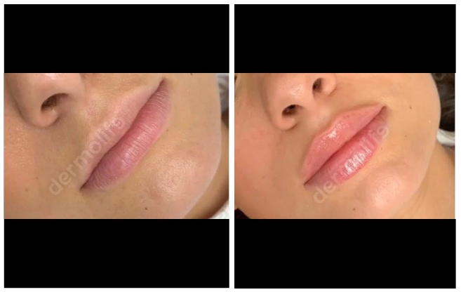 hyaluronic acid aesthetic clinic italy 