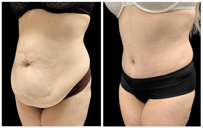 abdominoplasty aesthetic clinic italy 