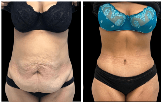 abdominoplasty aesthetic clinic italy 