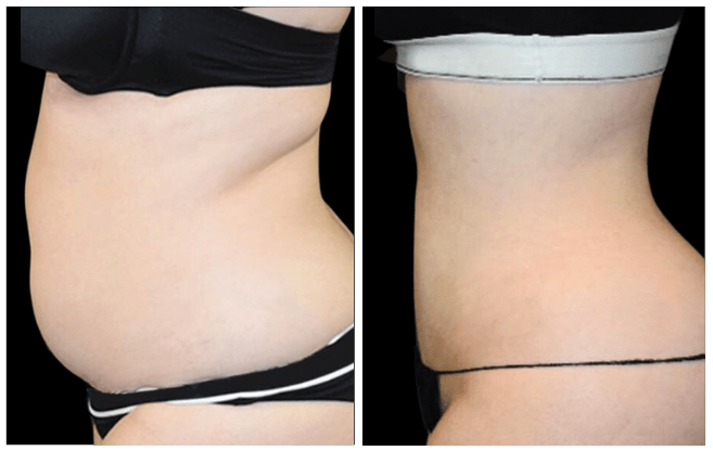 abdominoplasty aesthetic clinic italy 