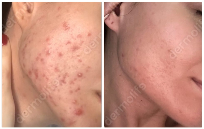 anti acne aesthetic clinic italy 