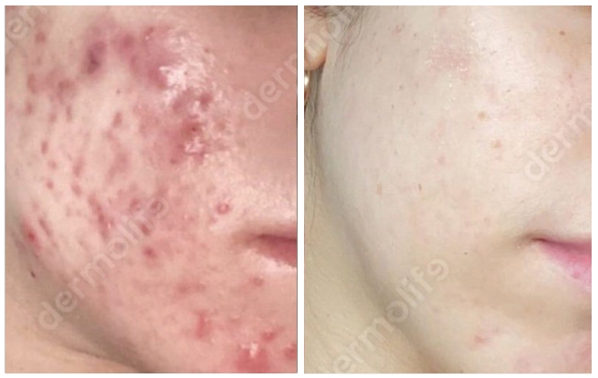 anti acne aesthetic clinic italy 