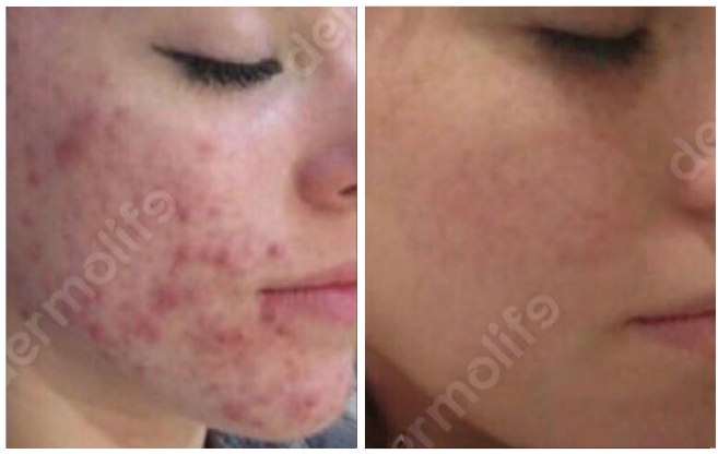 anti acne aesthetic clinic italy 