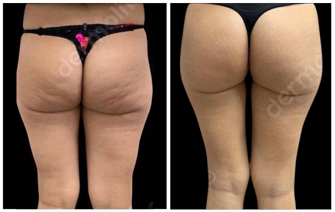 anticellulite clinic aesthetic italy 