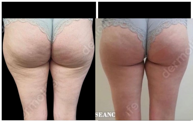 anticellulite clinic aesthetic italy 