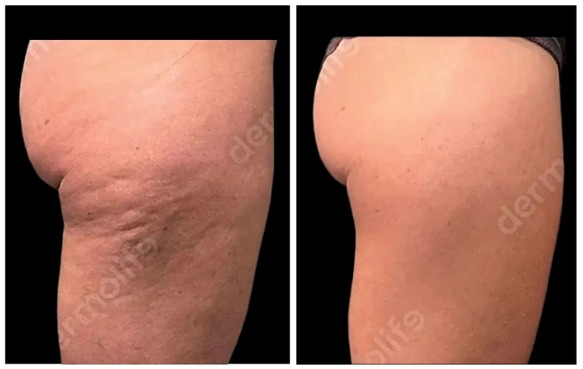 anticellulite clinic aesthetic italy 