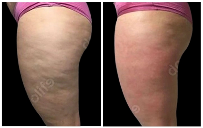 anticellulite clinic aesthetic italy 