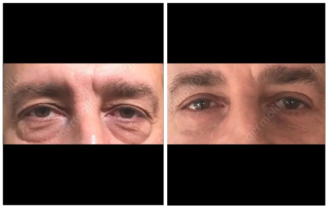 blepharoplasty aesthetic clinic italy 