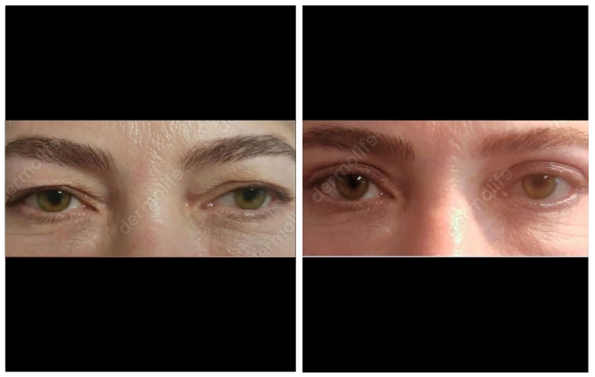 blepharoplasty aesthetic clinic italy 