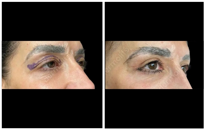blepharoplasty aesthetic clinic italy 
