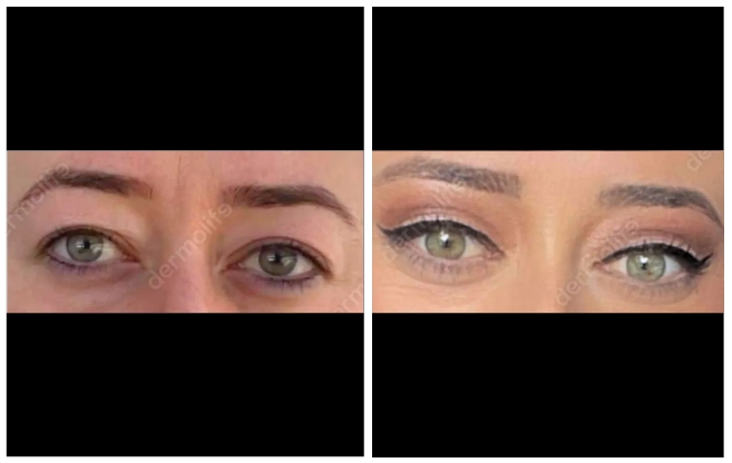 blepharoplasty aesthetic clinic italy 