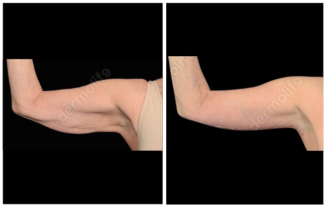 braccia clinica estetica italy 
