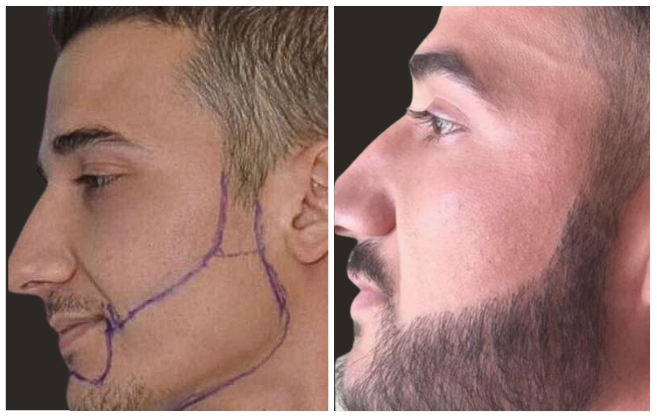 beard hair transplant aesthetic italy