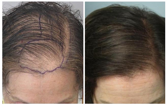 trapianto-capelli donna clinica estetica italy 1 
