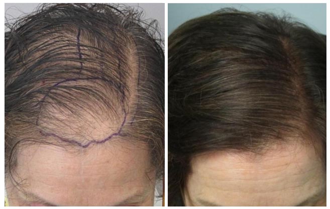 hair transplant woman aesthetic clinic italy 1