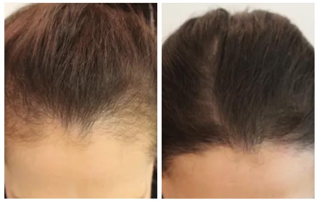 hair transplant woman aesthetic clinic italy