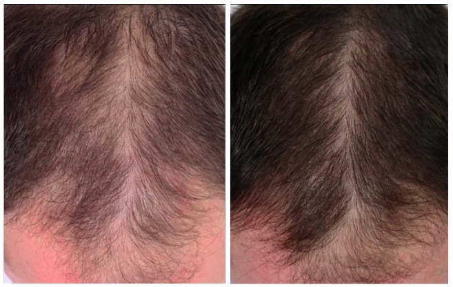 PRP treatment 2
