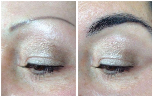trapianto sopracciglia clinica estetica italy