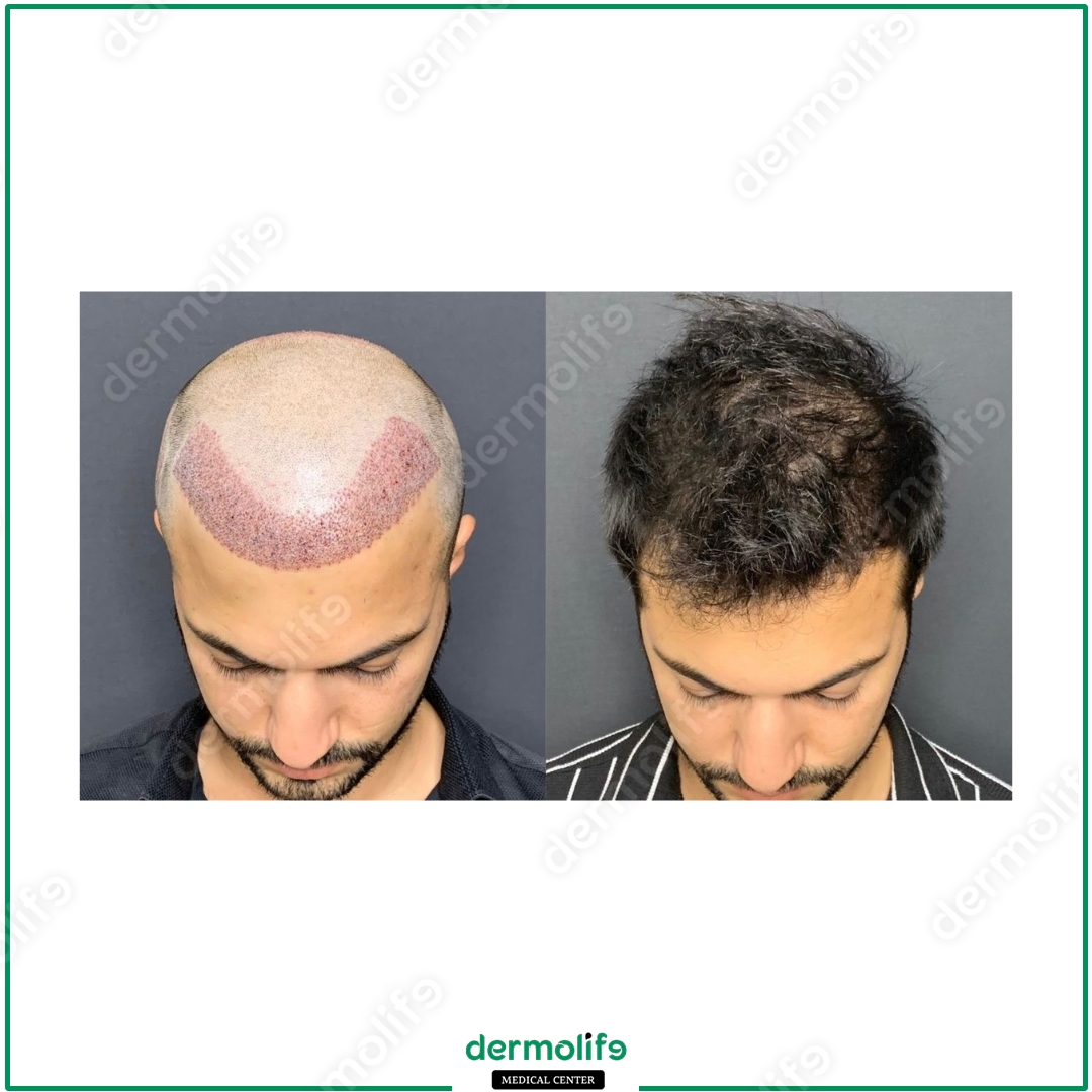 Trapianto Capelli clinica estetica italy 