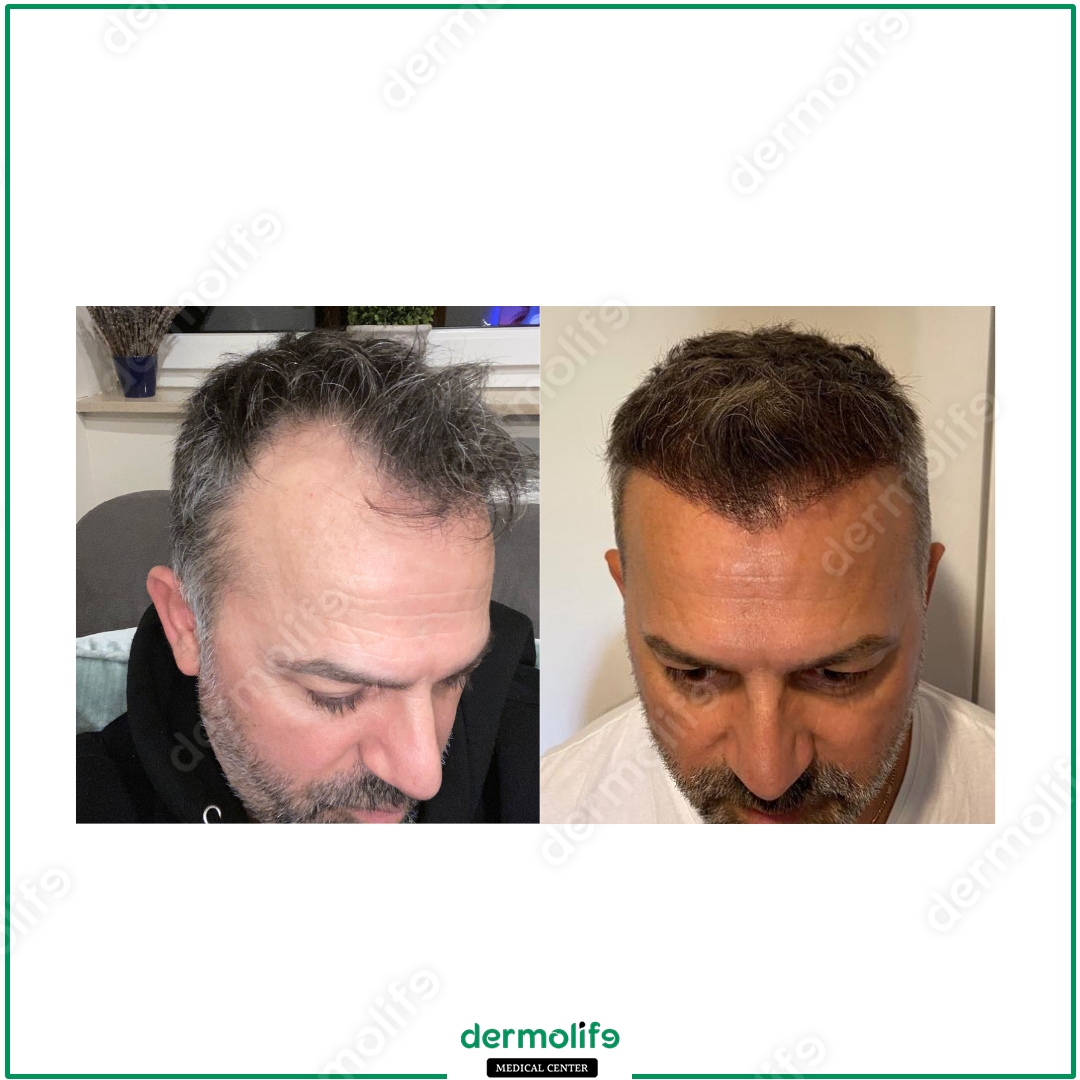 Trapianto Capelli clinica estetica italy 