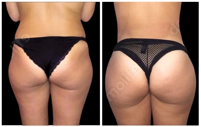 gluteoplastica clinica estetica italy 